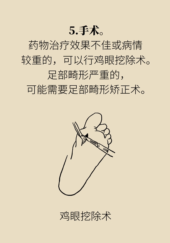 長了雞眼和老繭怎么辦？這份防治指南請收好