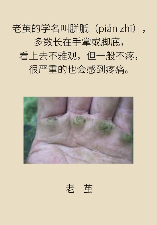 長了雞眼和老繭怎么辦？這份防治指南請收好