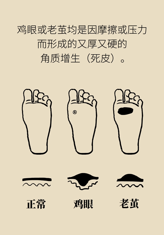 長了雞眼和老繭怎么辦？這份防治指南請收好