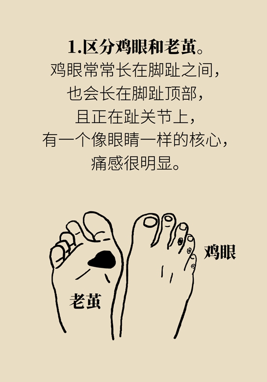 長了雞眼和老繭怎么辦？這份防治指南請收好
