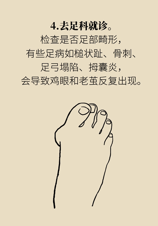 長了雞眼和老繭怎么辦？這份防治指南請收好