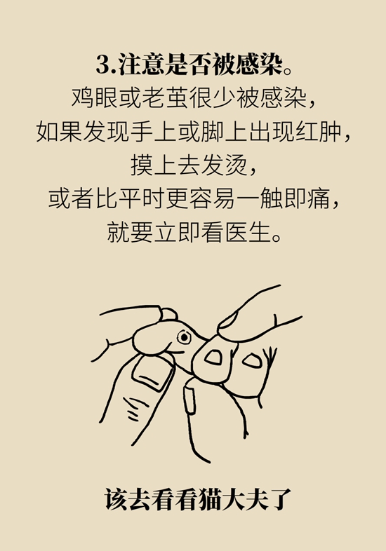 長了雞眼和老繭怎么辦？這份防治指南請收好