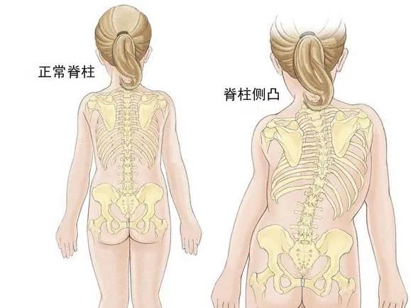 青少年睡姿不對(duì)，真能把脊柱睡“彎”嗎？