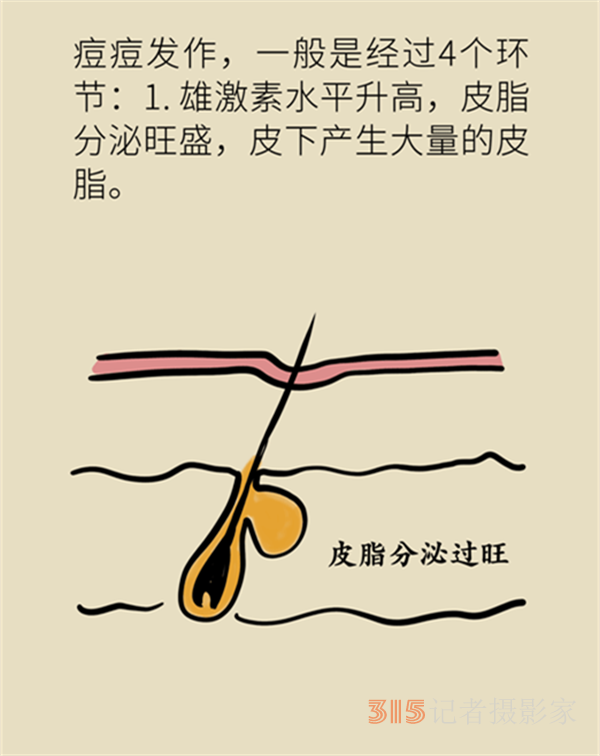 拯救顏值，請收下這份戰(zhàn)痘寶典！