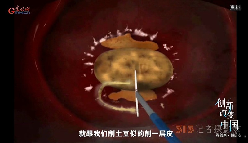 宮頸癌消滅戰(zhàn)：如何減少“梅艷芳式悲劇”？
